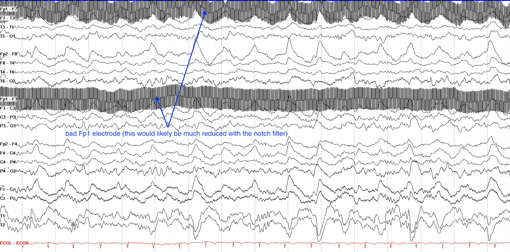 60 Hz electrode artifact