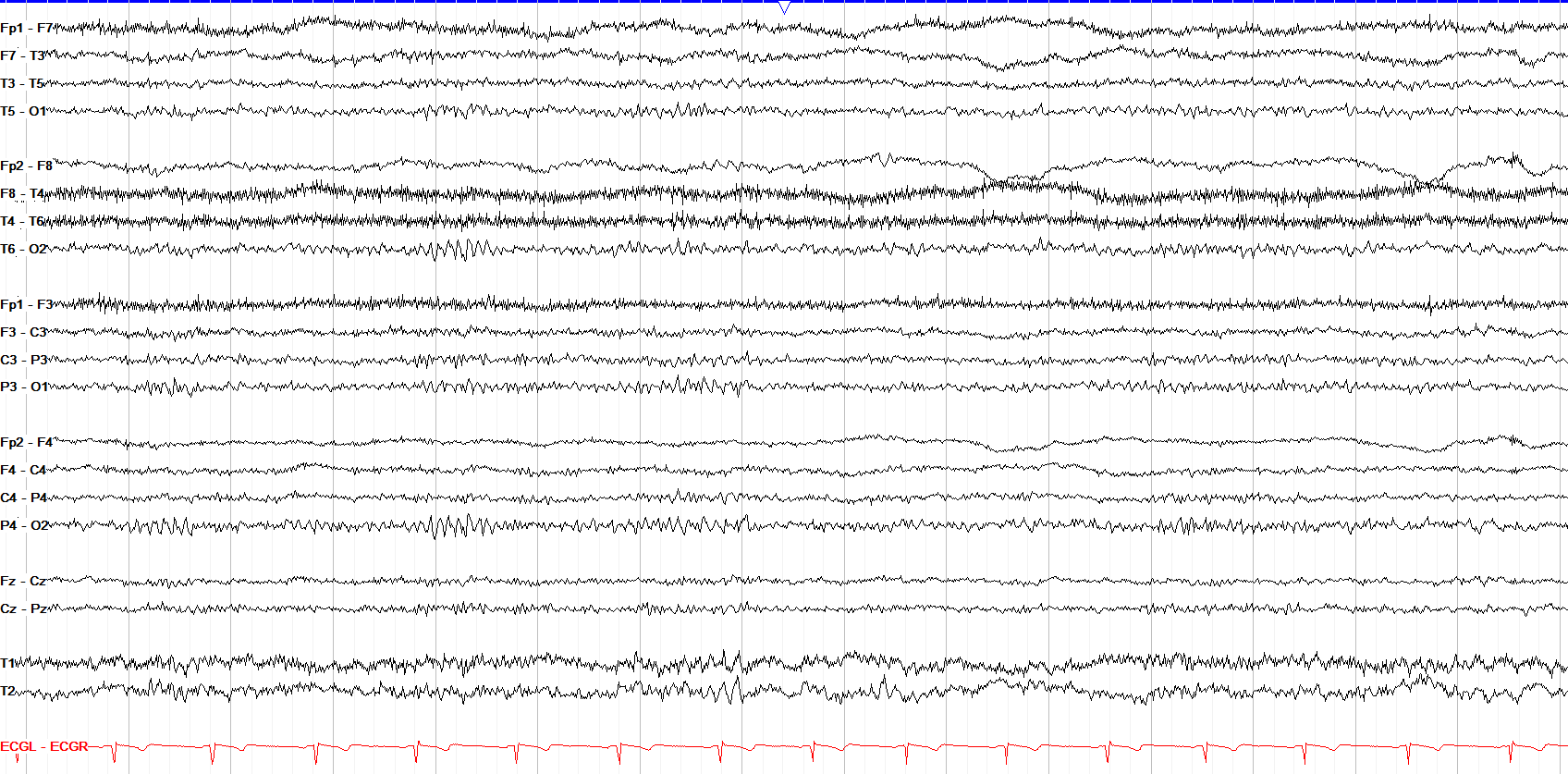 Slow lateral eye movements