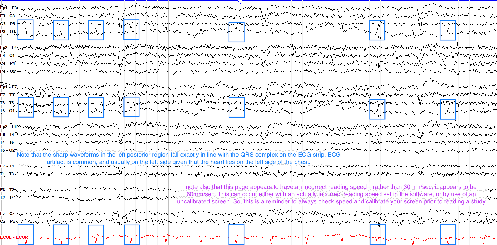ECG artifact
