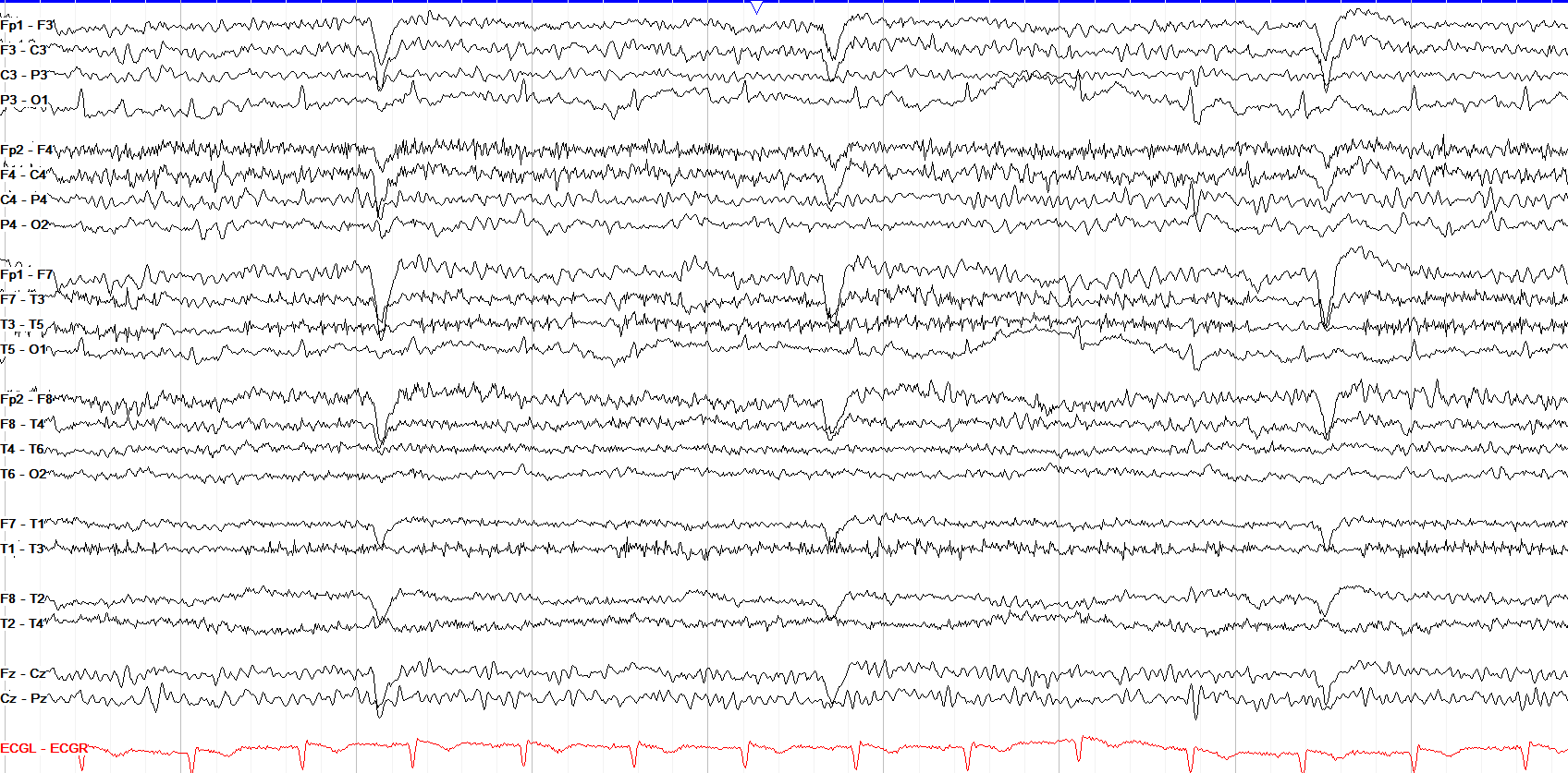 ECG artifact