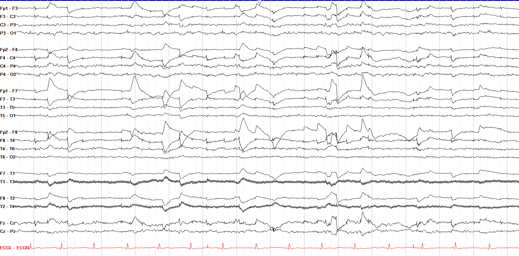 Lateral eye movement in REM