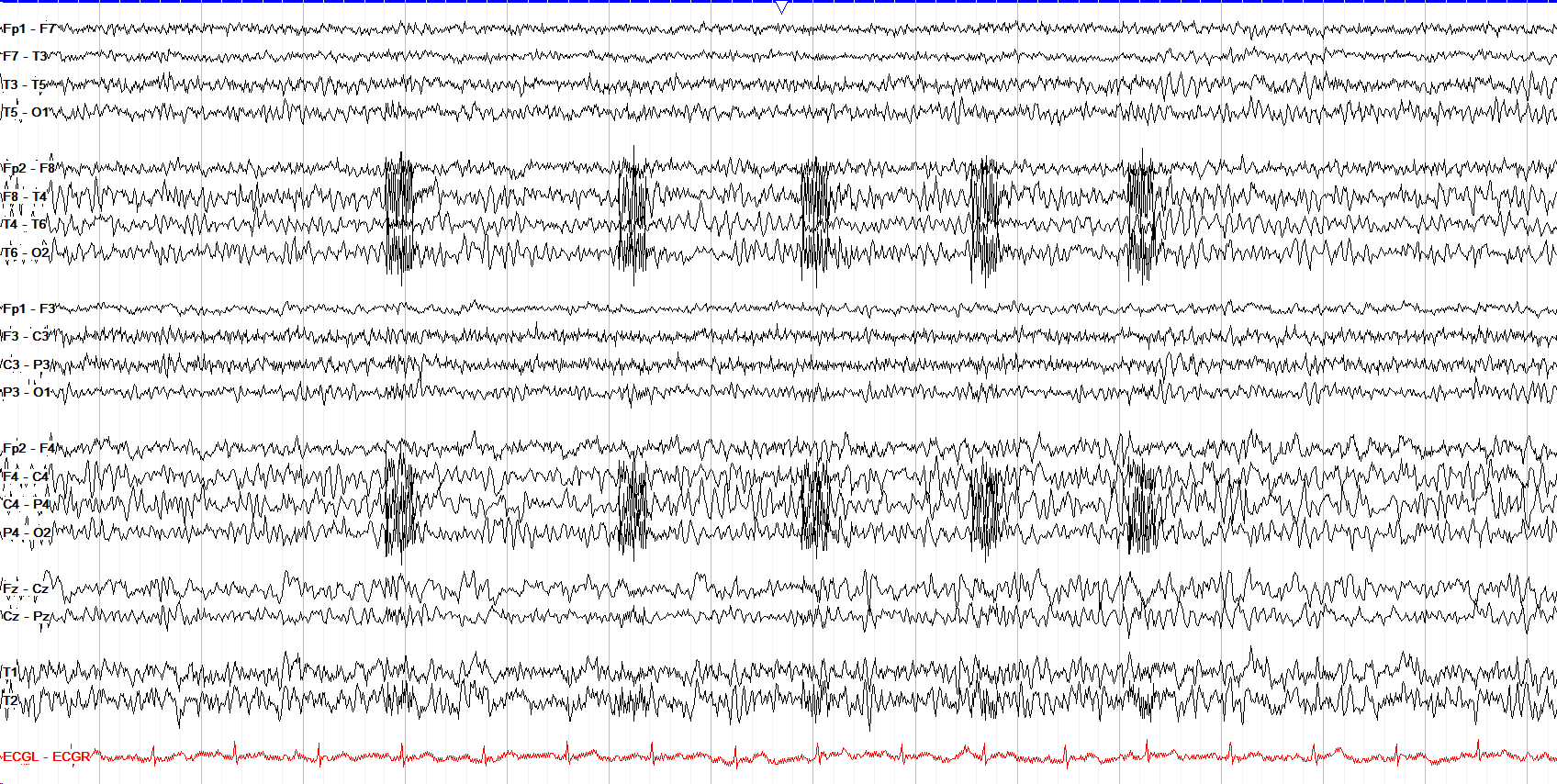 RNS stimulation artifact