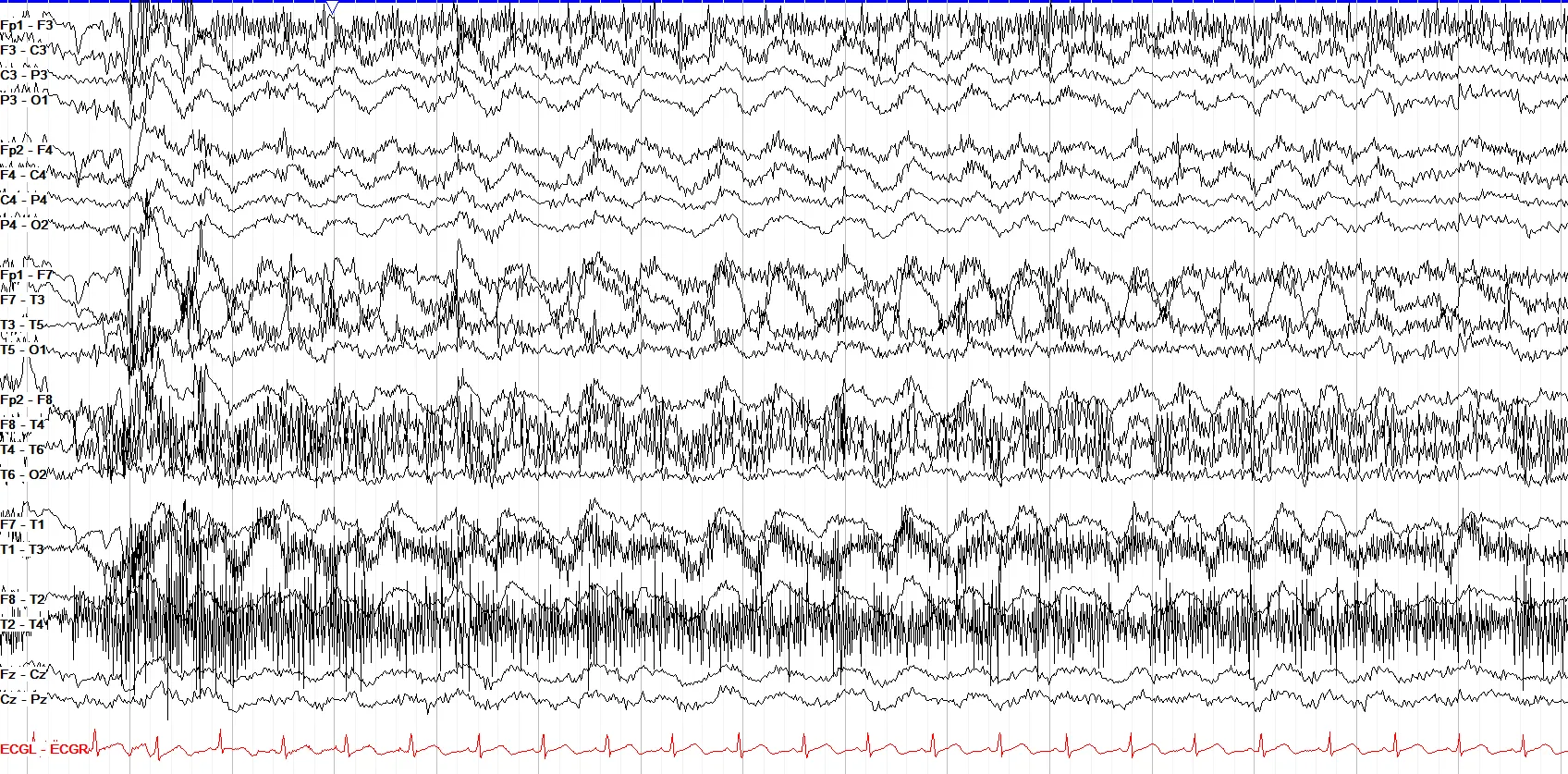 Hypoglossal and Myogenic