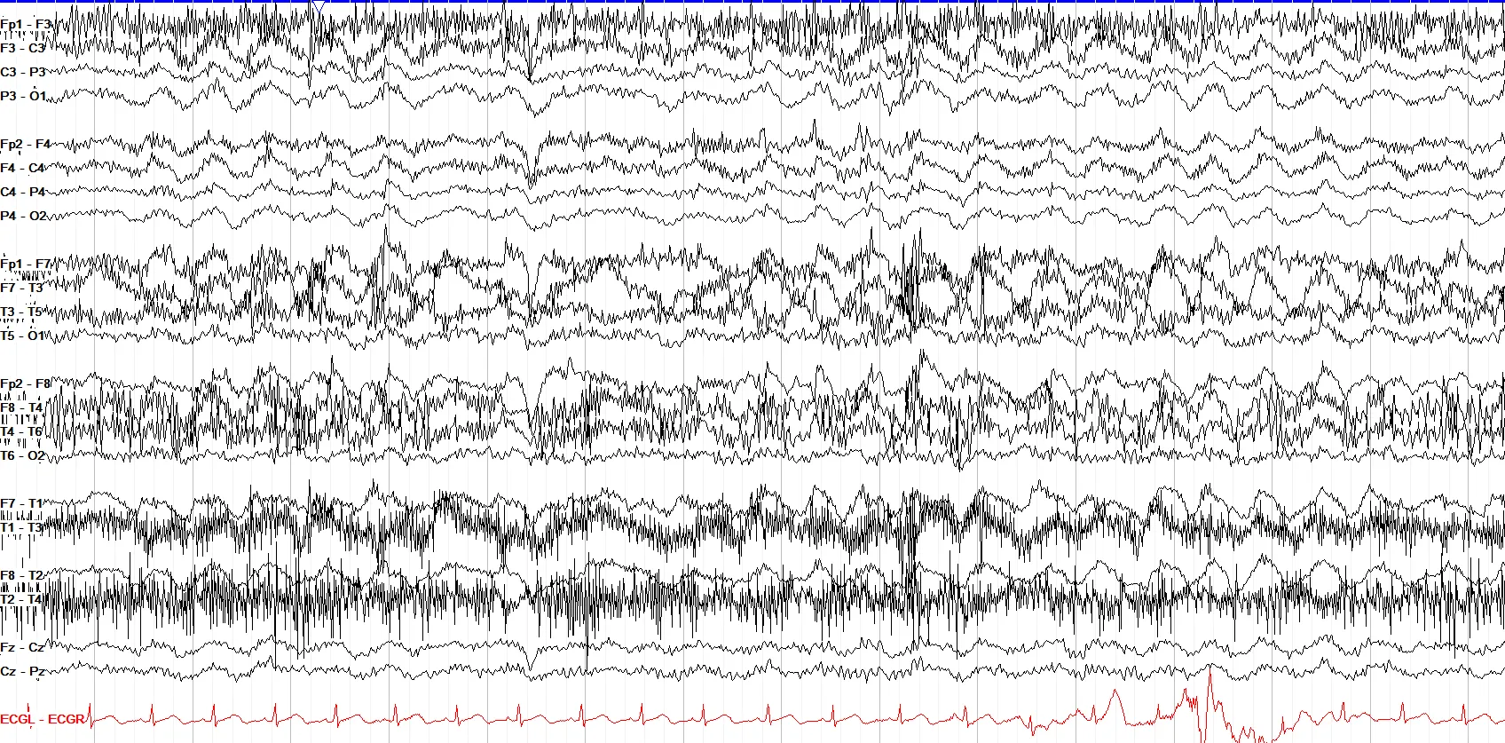 Hypoglossal artifact