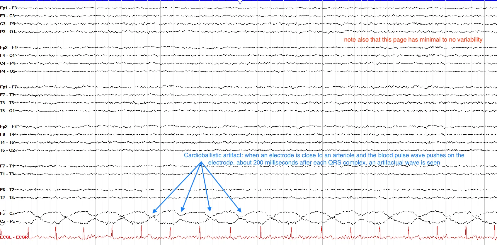 Cardioballistic artifact