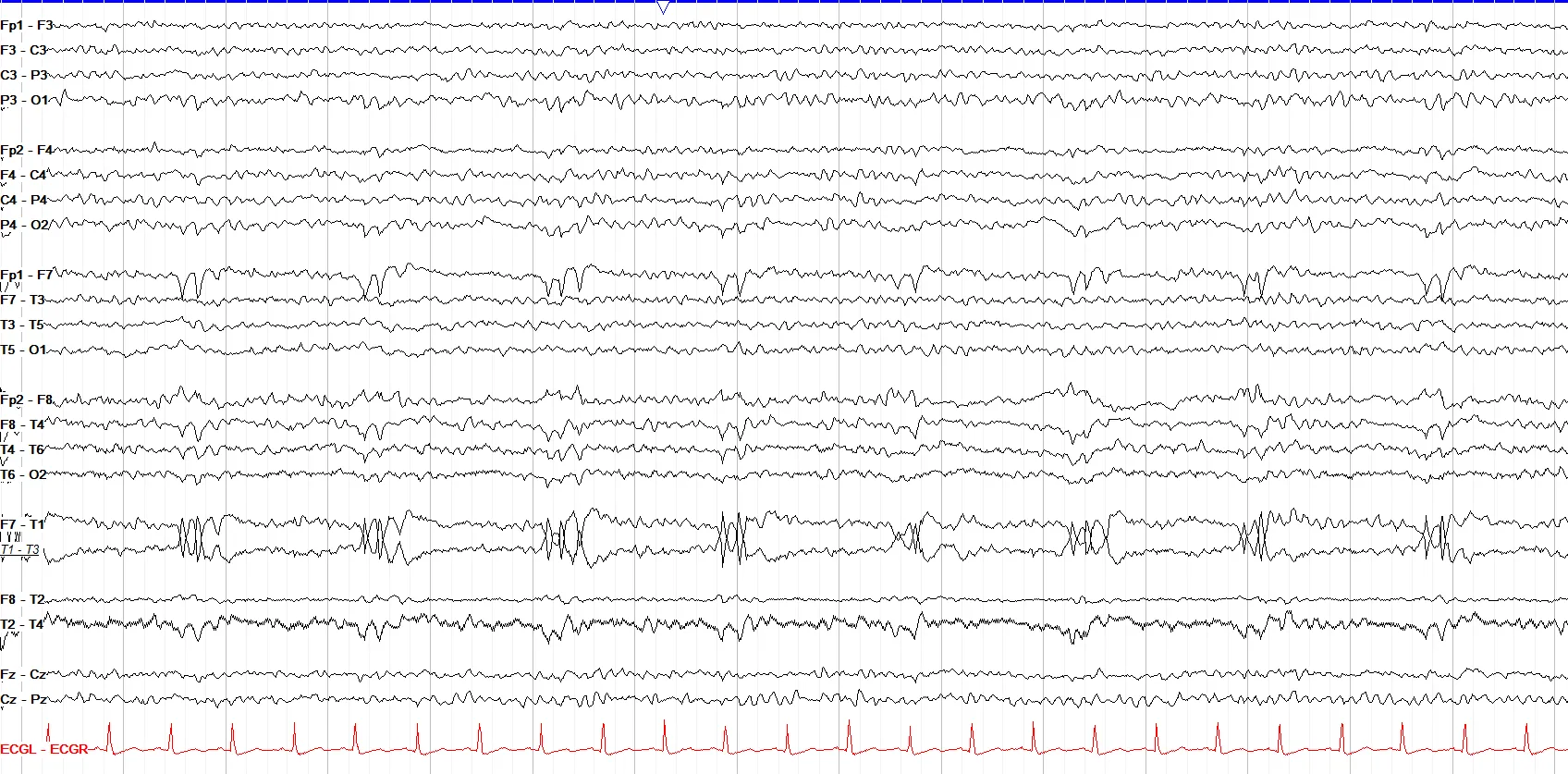 Ventilator artifact