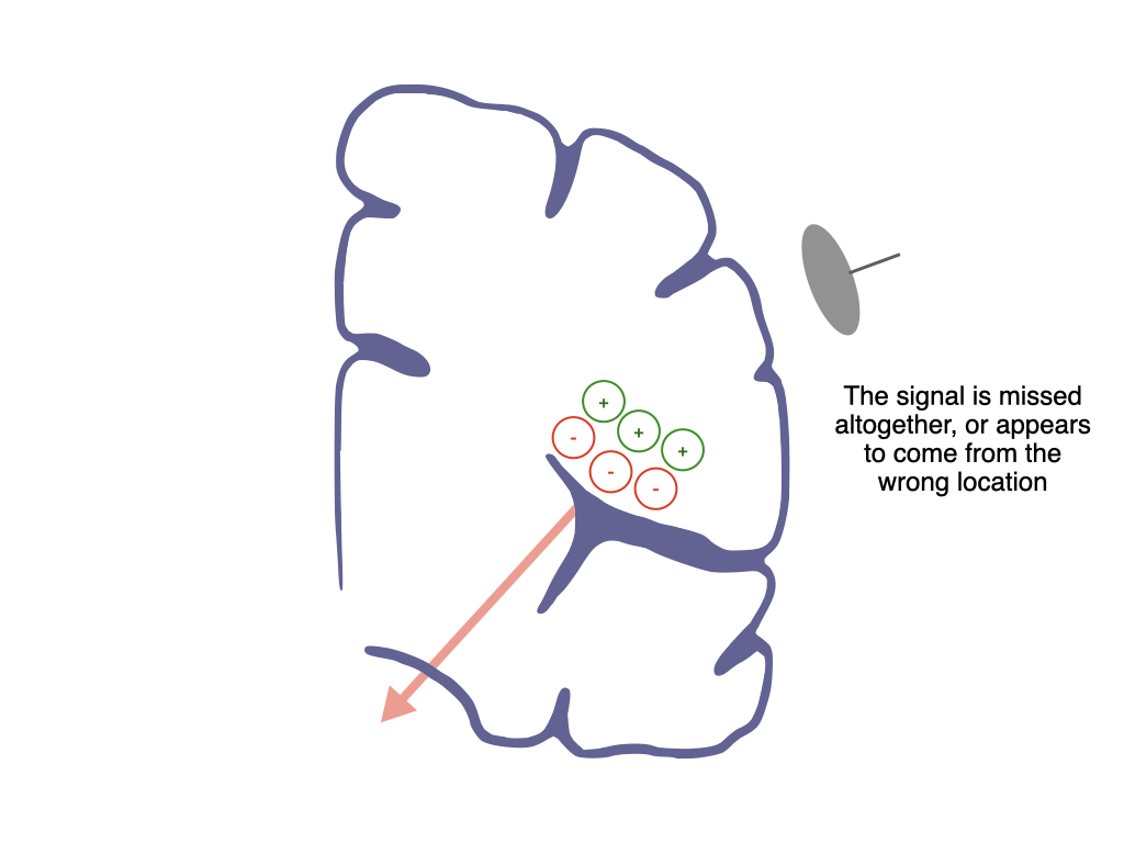 Dipole signal missed or mislocalized to wrong location