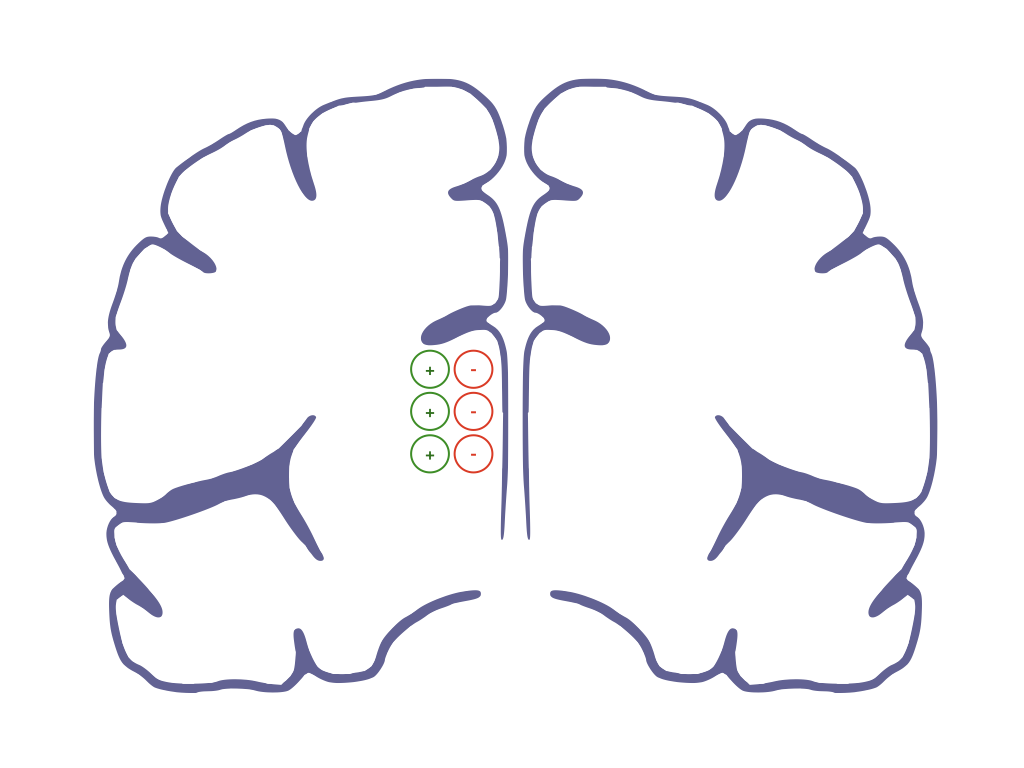 Dipole question — interhemispheric fissure