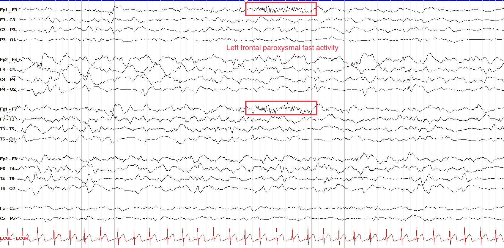 Paroxysmal Fast Activity