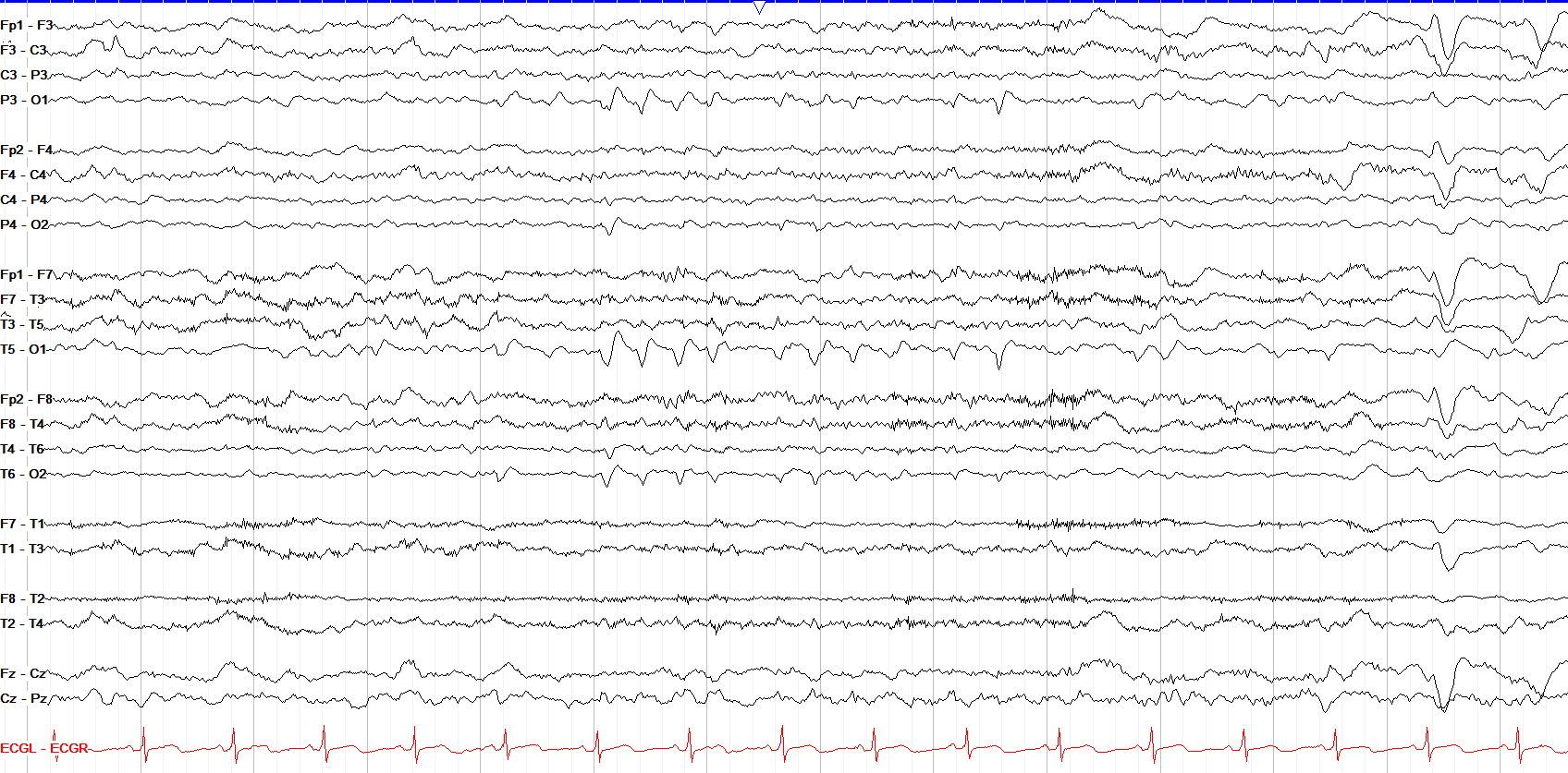 O1 discharges
