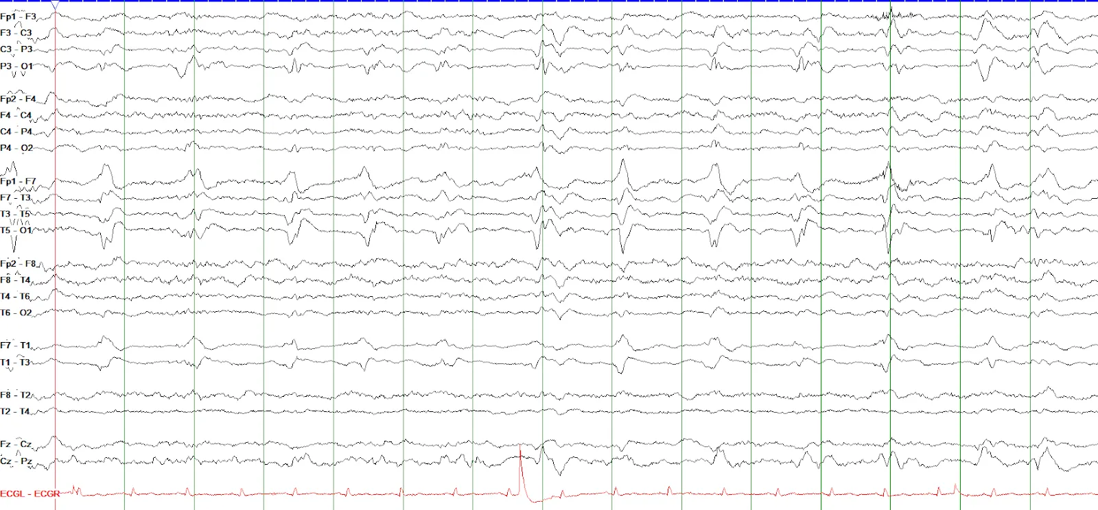 Broad left temporal 0.75 Hz LPDs