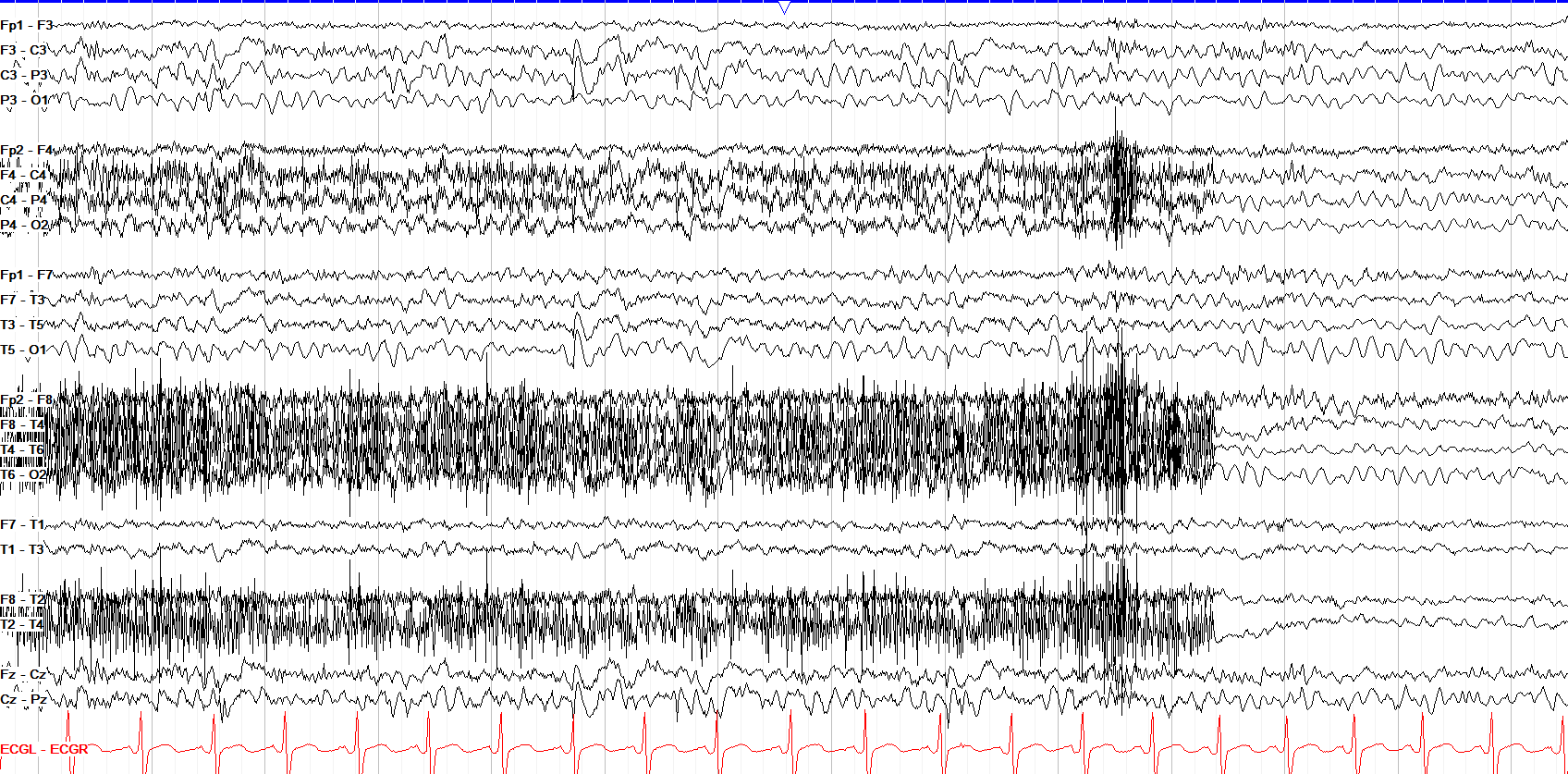 Bilateral centro-parietal spike and wave