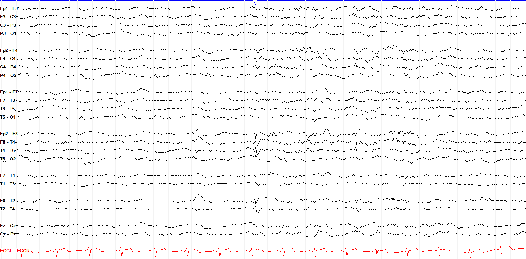 Right temporal spike