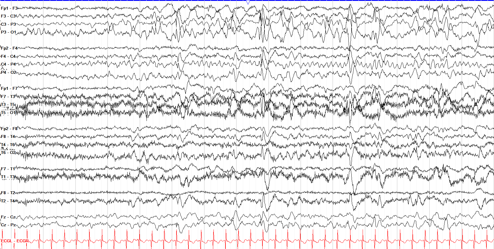 Bisynchronous P3 max spikes