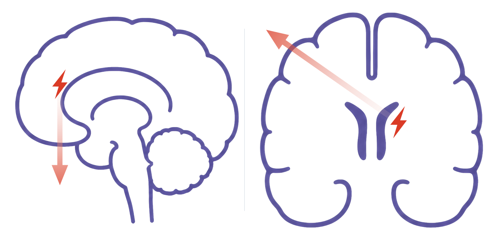 Sagittal schematic of a dipole pointing away from the scalp, beside a coronal schematic of a medial wall discharge pointing across the midline