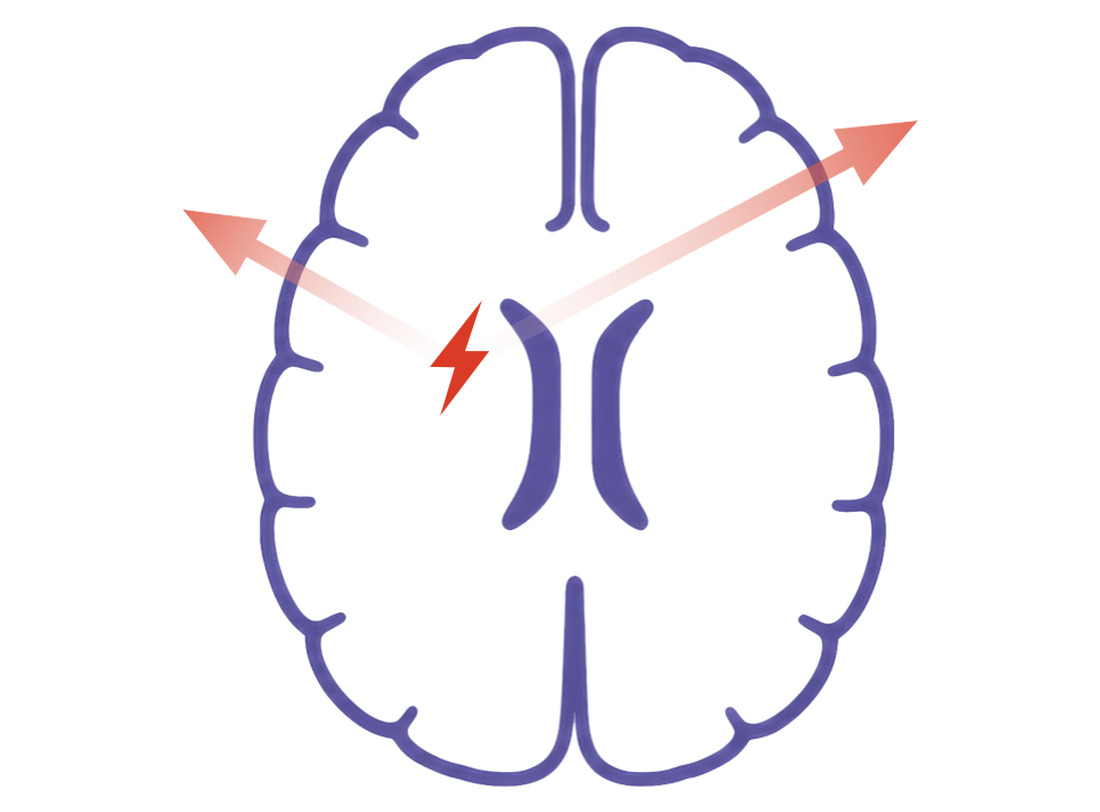 Axial schematic of a focal discharge propagating rapidly to both frontal regions