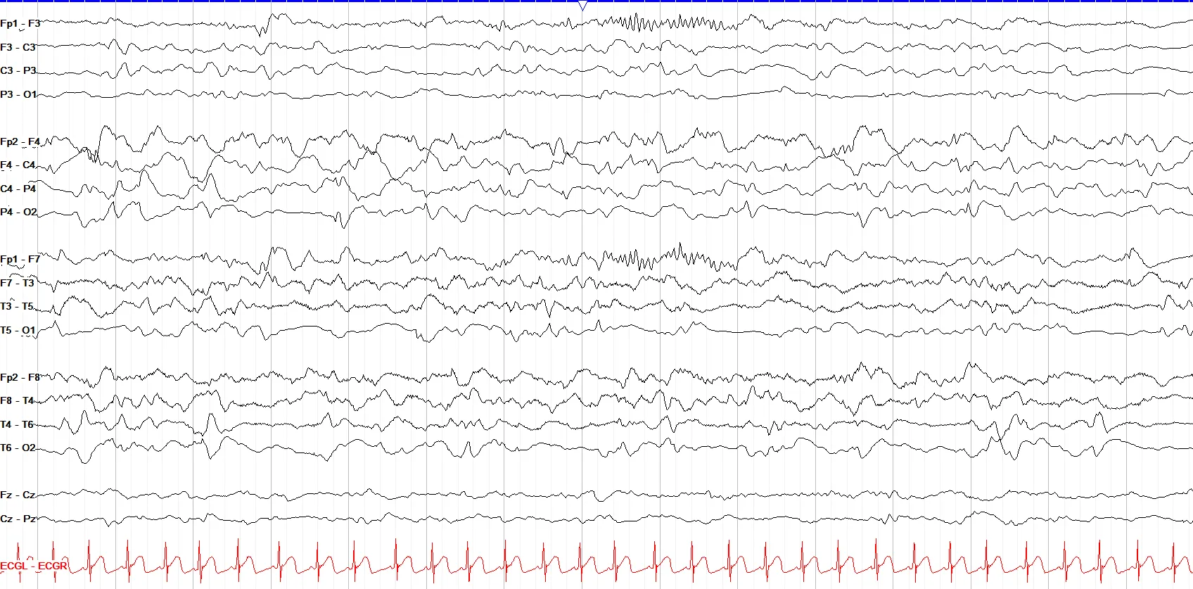 Left frontal paroxysmal fast activity