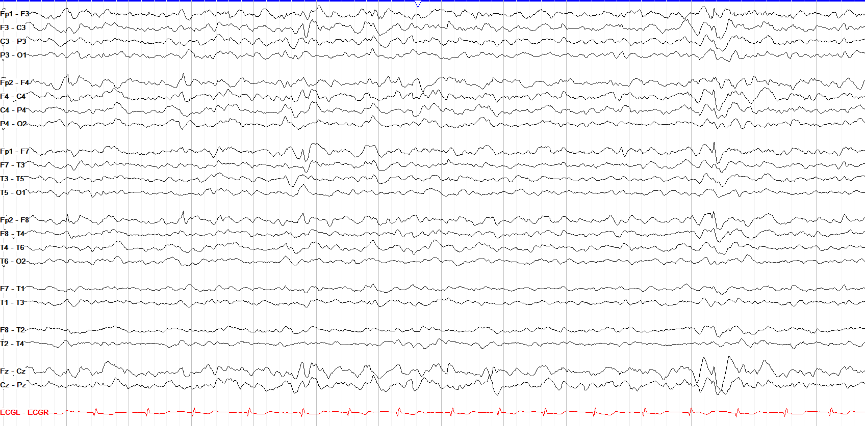 Left frontal Spike and Wave with some Right Field / Spread