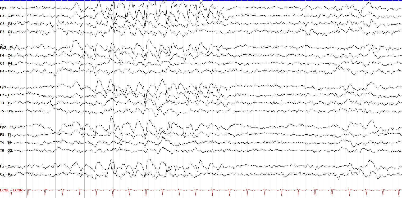 Left > right bi-frontocentral spikes