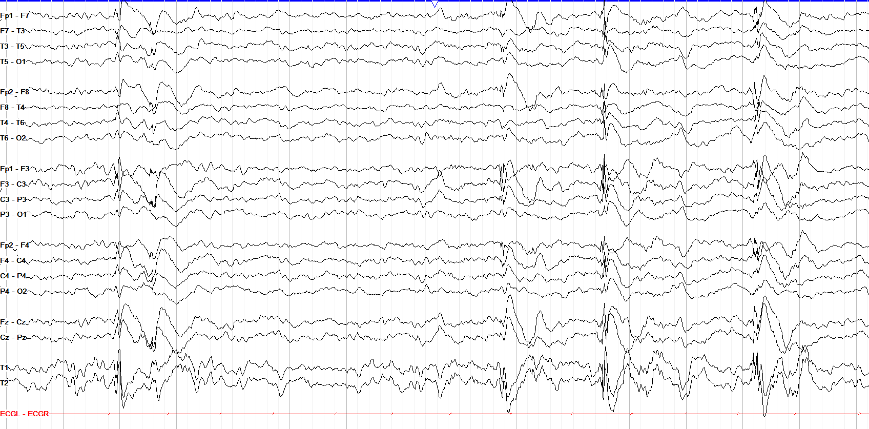 Generalized spike and waves