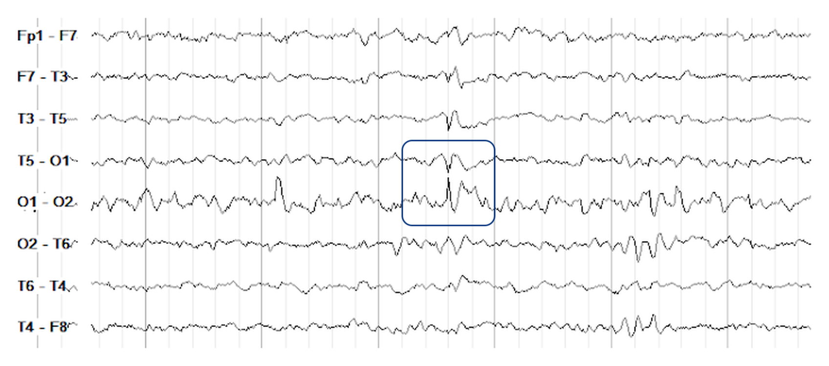 A left occipital spike producing a phase reversal at O1 in a circumferential bipolar montage, boxed across T5-O1 and O1-O2