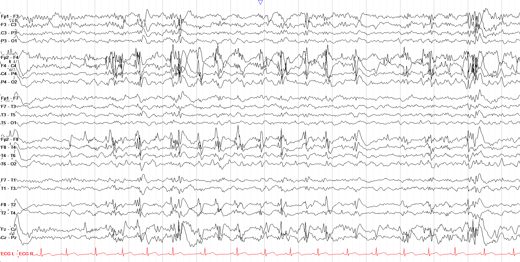 Right Frontotemporal Periodic 1.5 Hz Polyspike and Wave Run