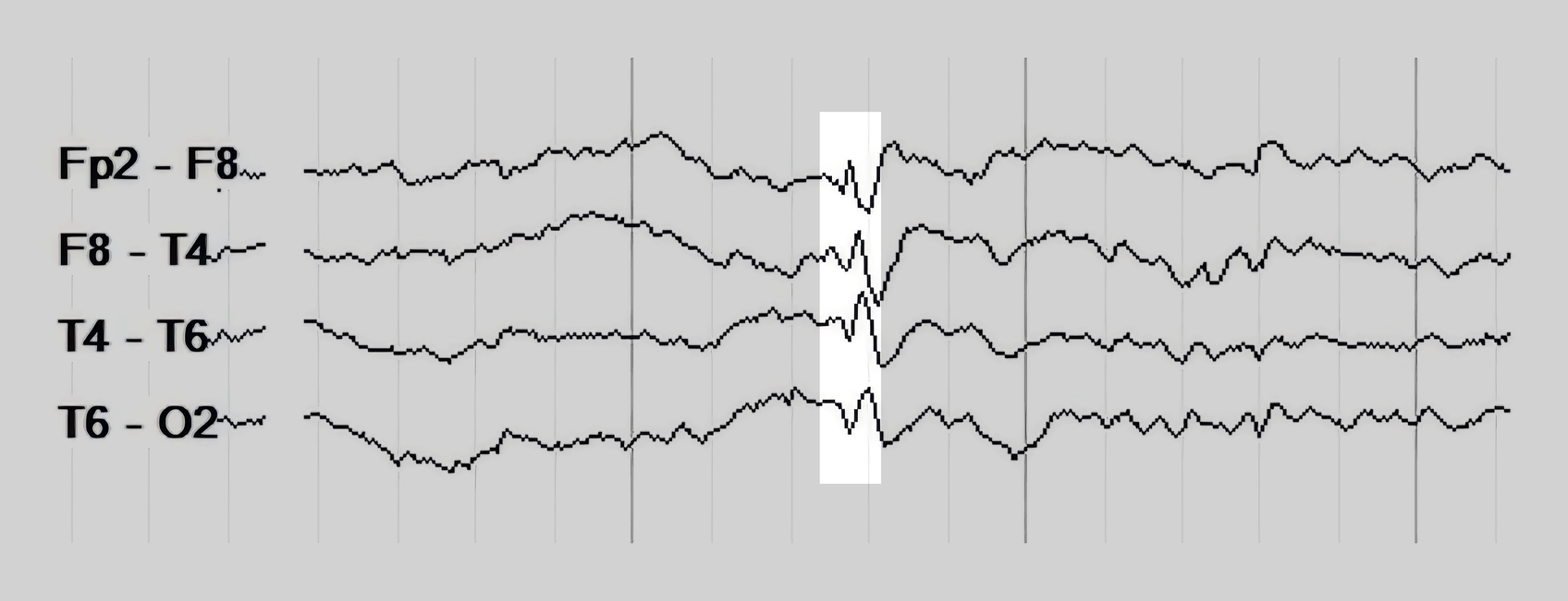 A right temporal spike, highlighted to show its pointed peak