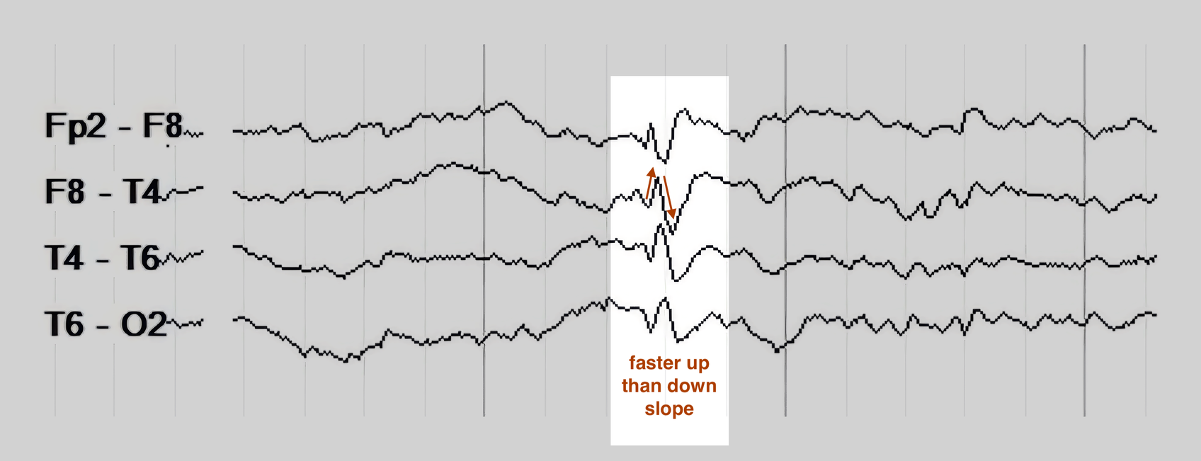 The same spike, marked to show its faster upslope than downslope