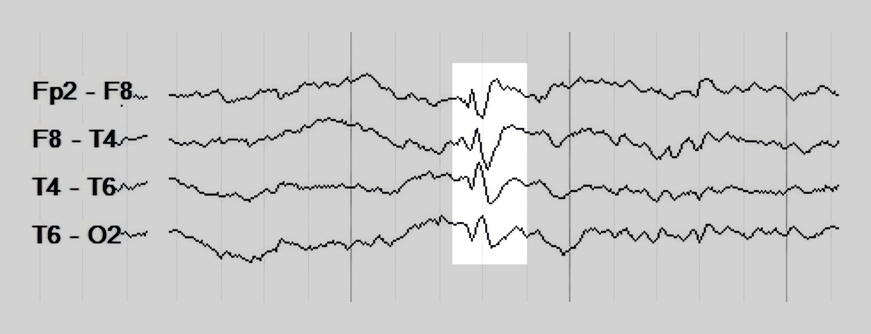 The same spike with its after-going slow wave highlighted