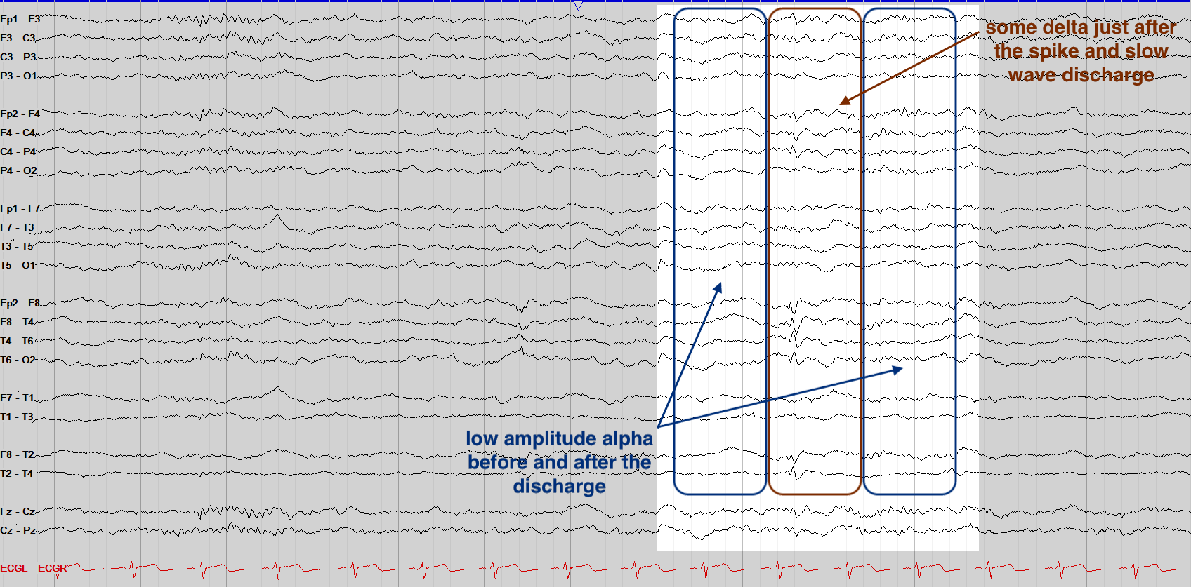 The full tracing, showing low amplitude alpha before and after the discharge and some delta around the slow wave