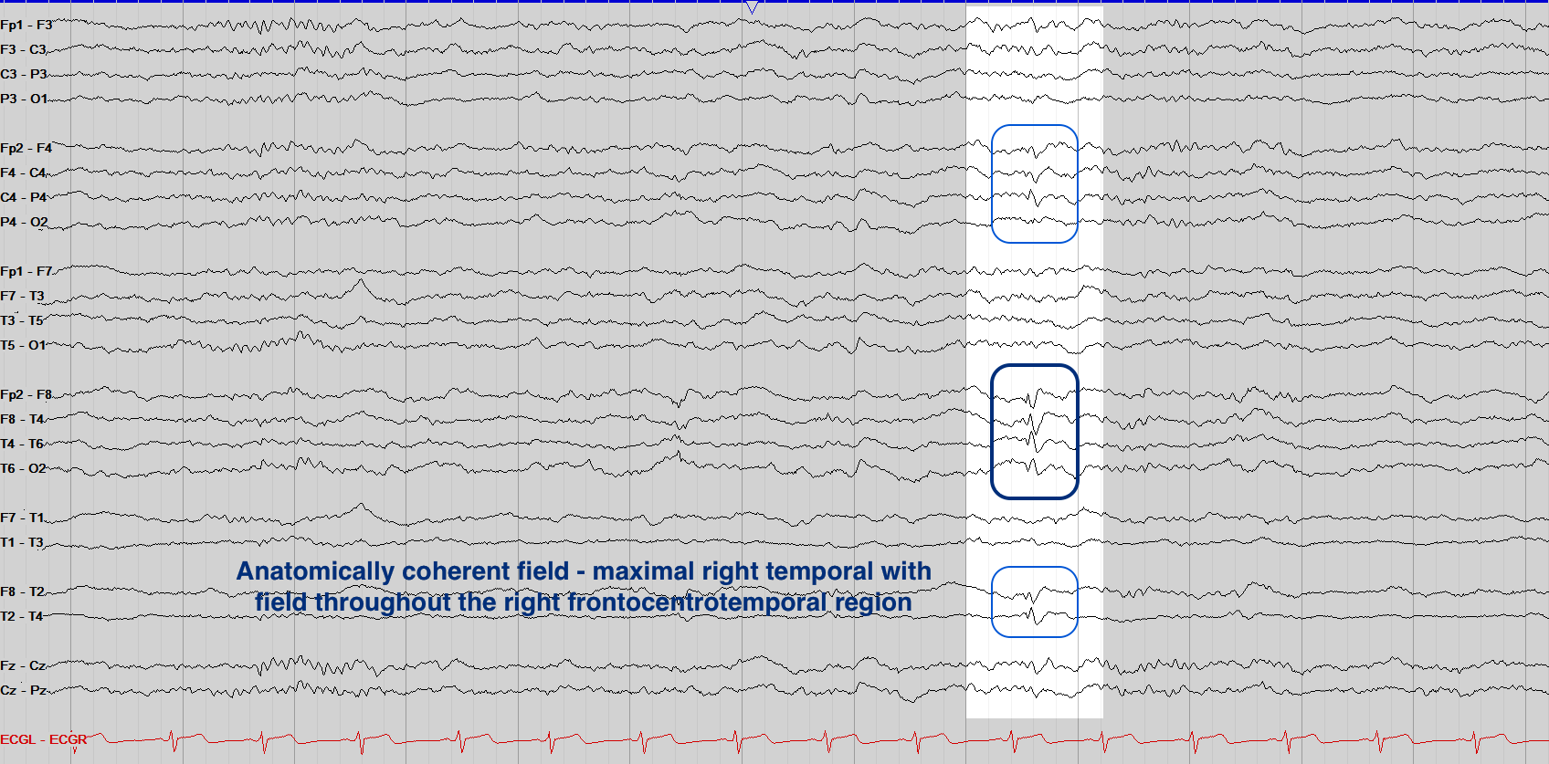 The full tracing, showing the discharge maximal in the right temporal region with a field through the right frontocentrotemporal region