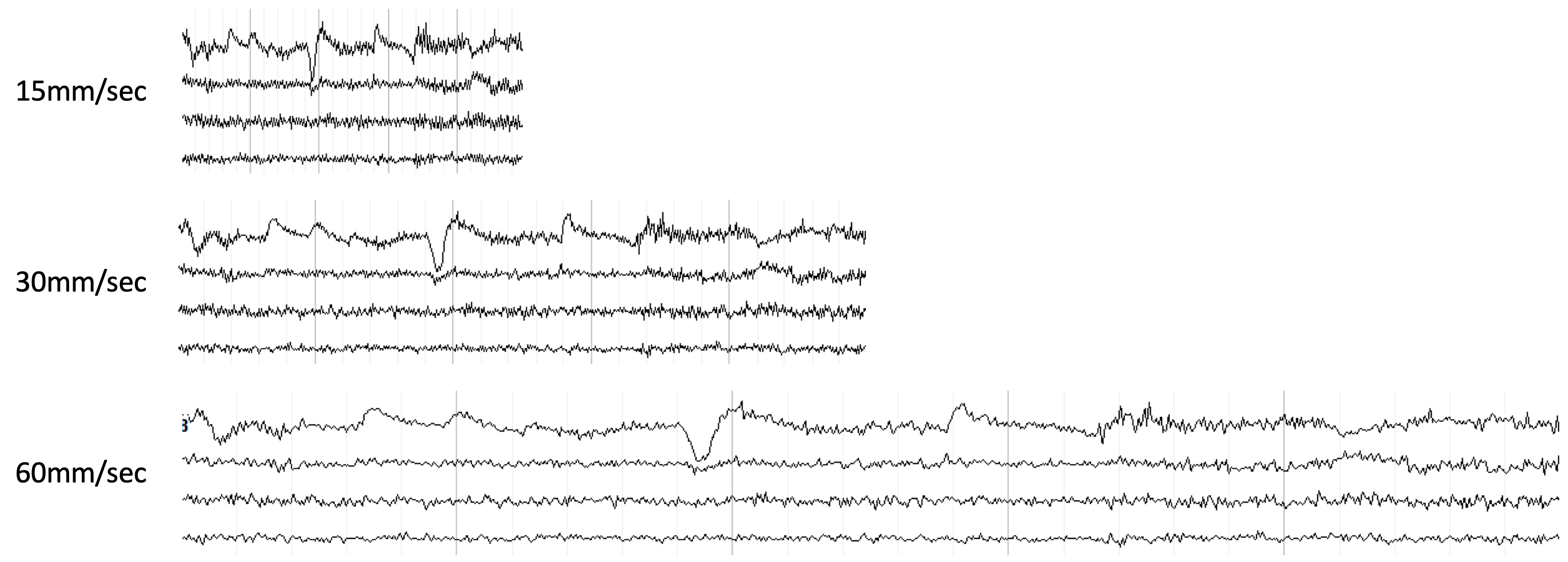 Comparison of page speeds showing the same waveforms at 15, 30, and 60 mm/sec