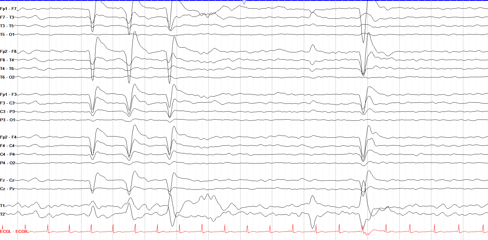 High Frequency Filter