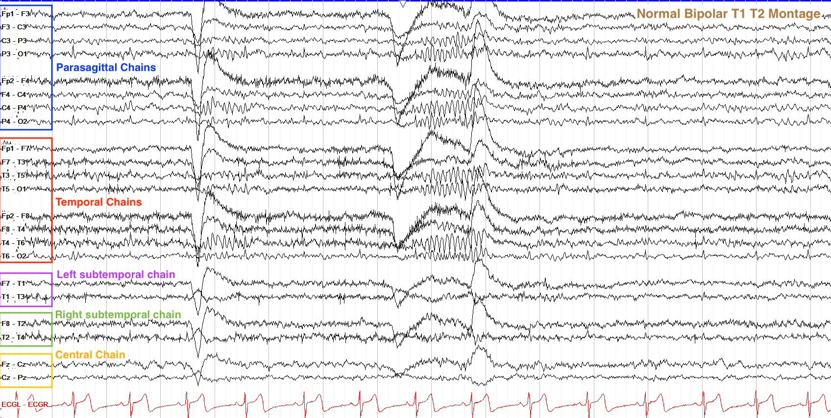 Annotated T1-T2 bipolar montage showing parasagittal and subtemporal chains