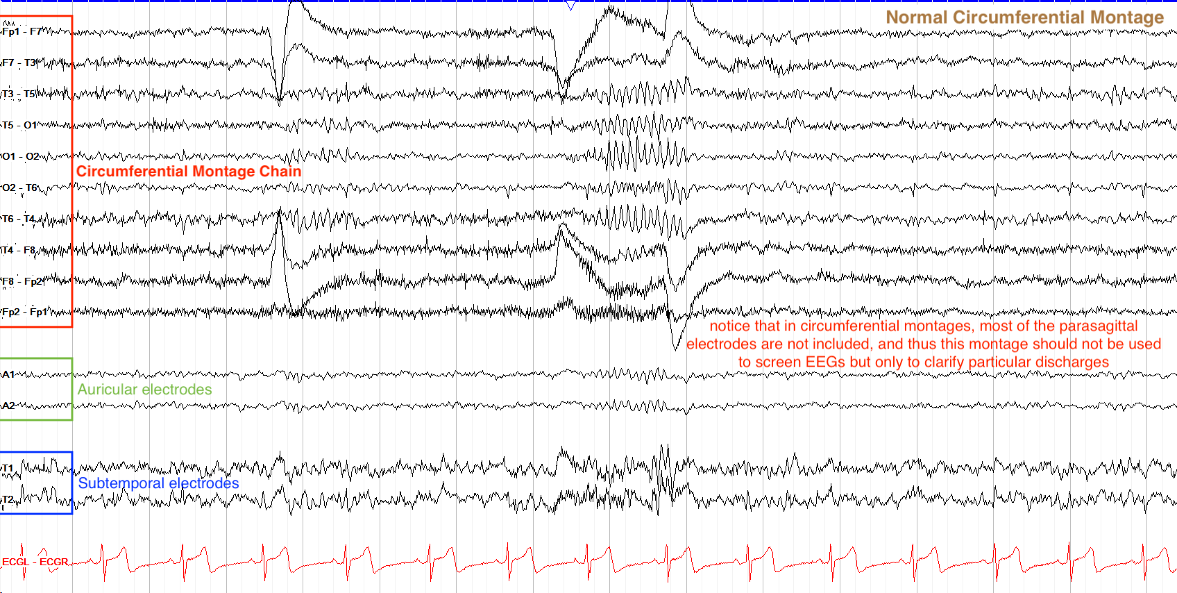 Annotated circumferential bipolar montage showing circular electrode chains