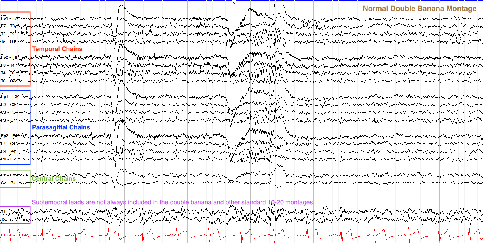 Annotated double banana bipolar montage showing temporal and parasagittal chains