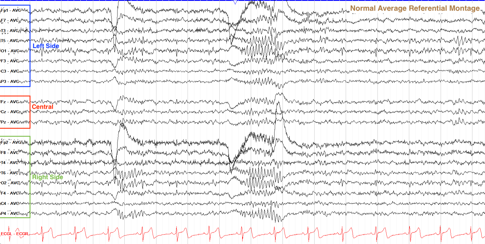 Annotated normal referential average montage showing all electrodes compared to a single reference