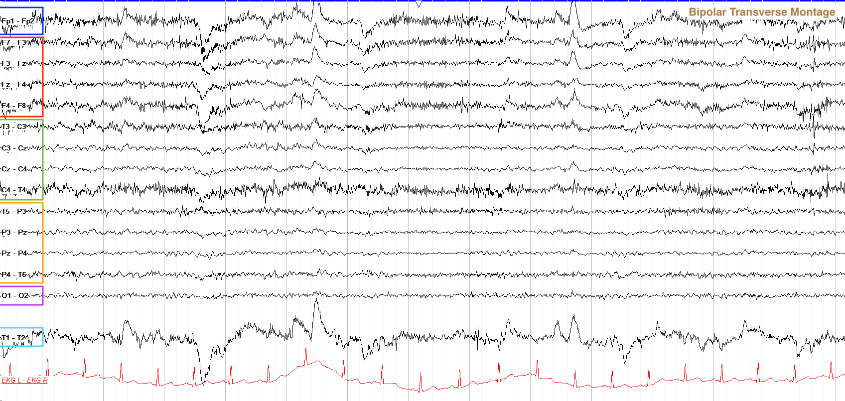 Annotated transverse bipolar montage showing left-to-right electrode chains