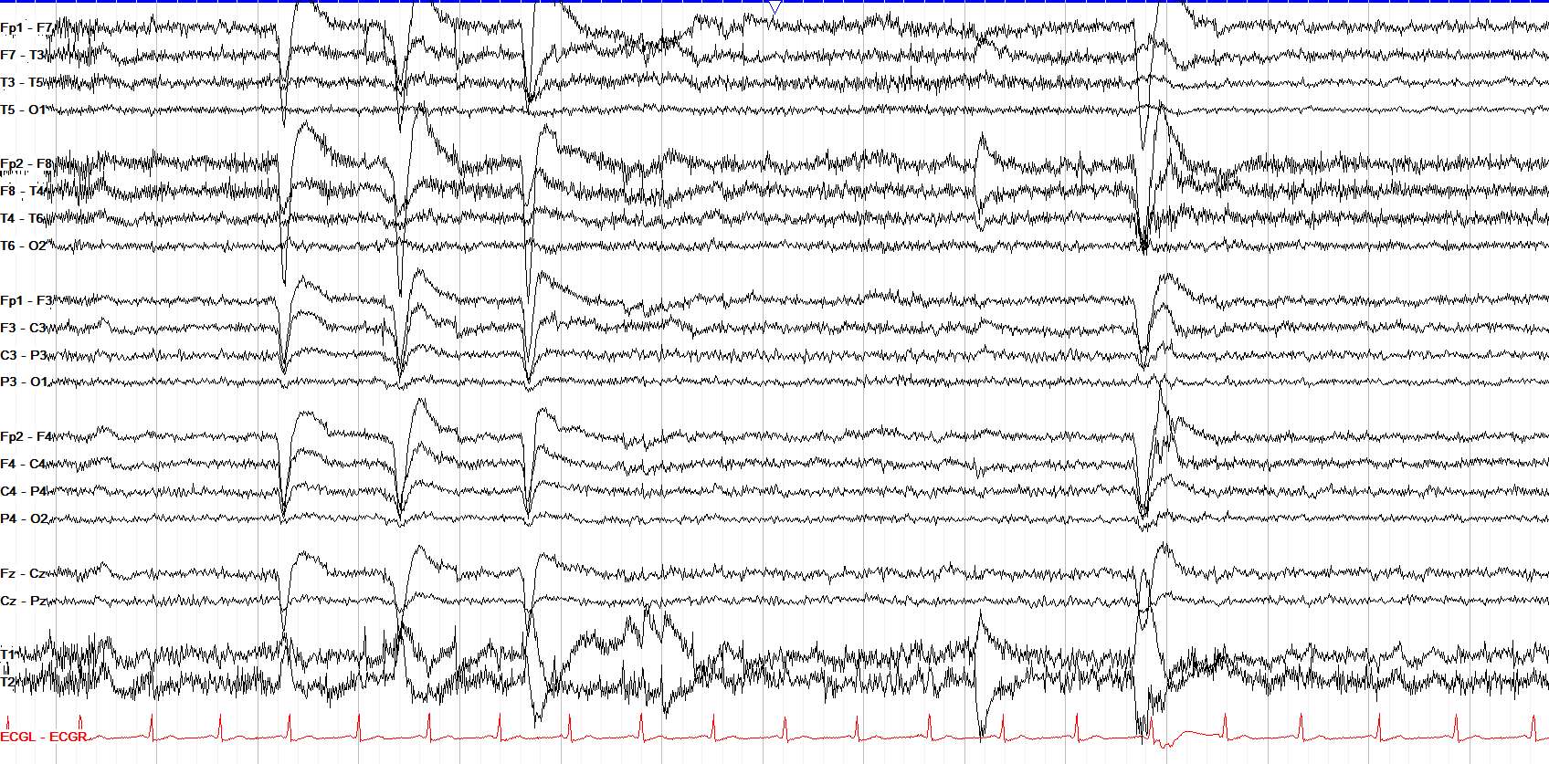 HFF off — no high frequency filtering, excessive artifact visible
