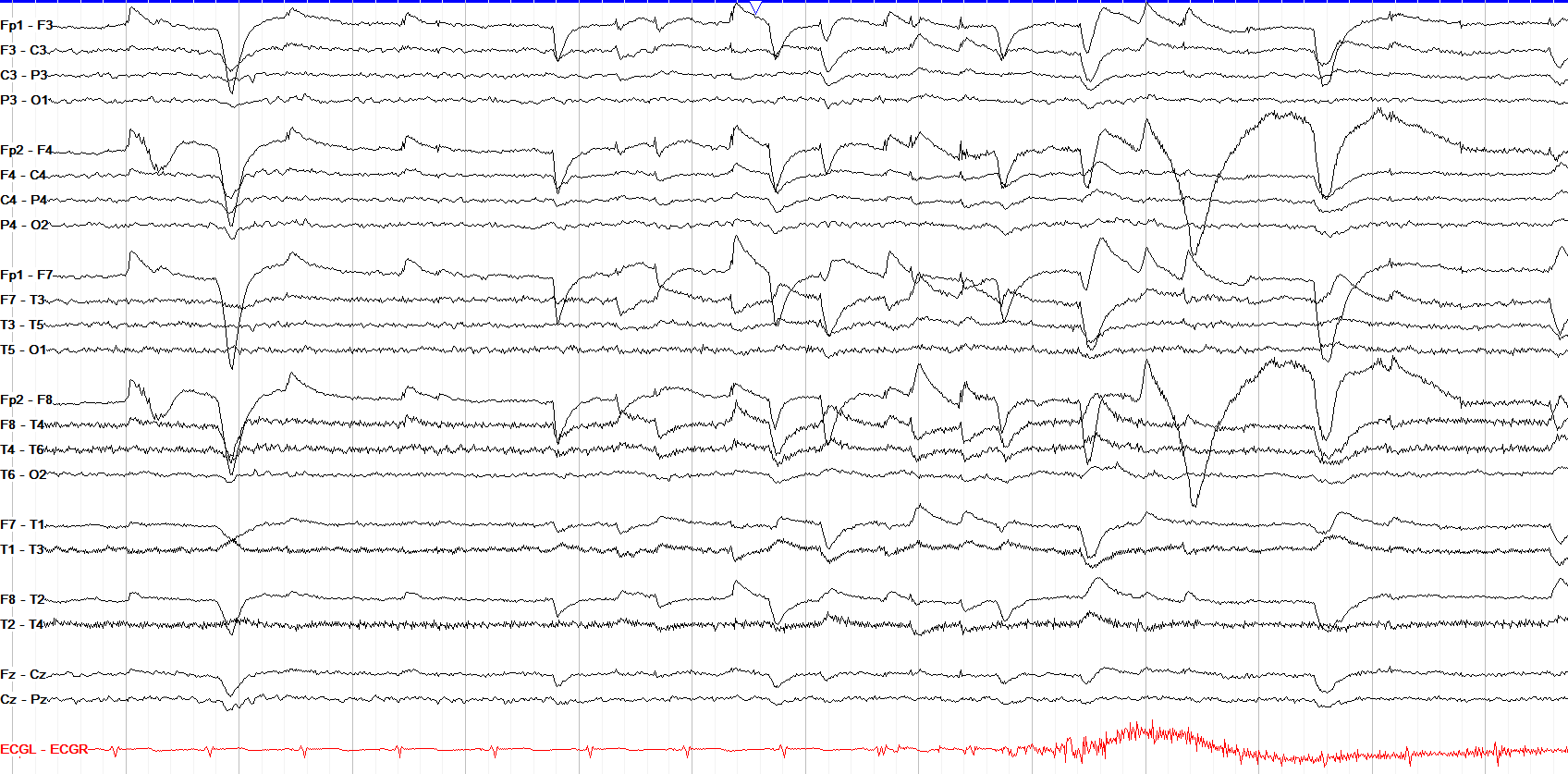 Positive and Negative Phase Reversals