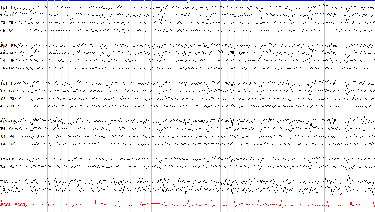Frontal myogenic tracing with HFF lowered to 15 Hz