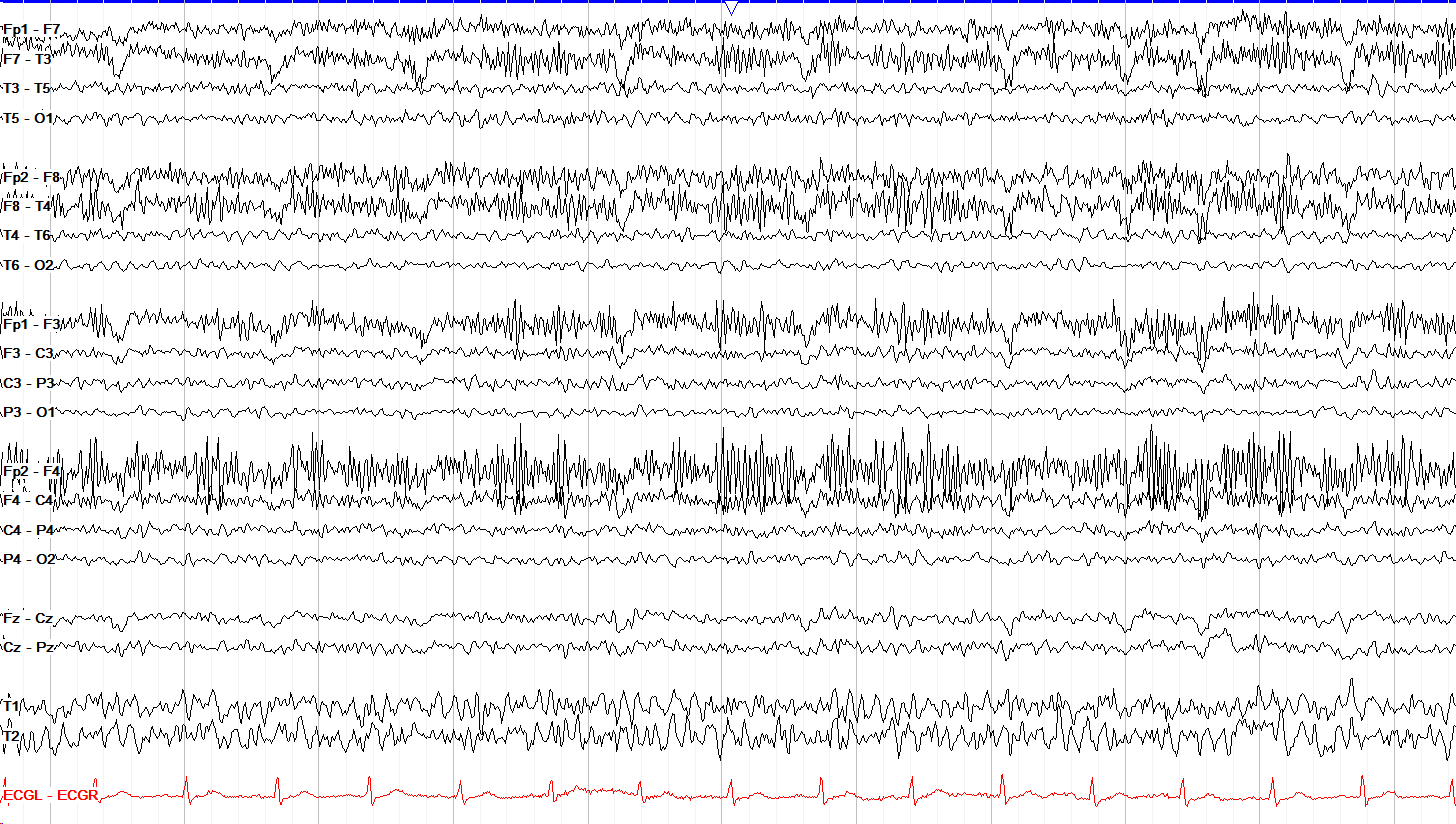 Frontal myogenic tracing with HFF lowered to 30 Hz