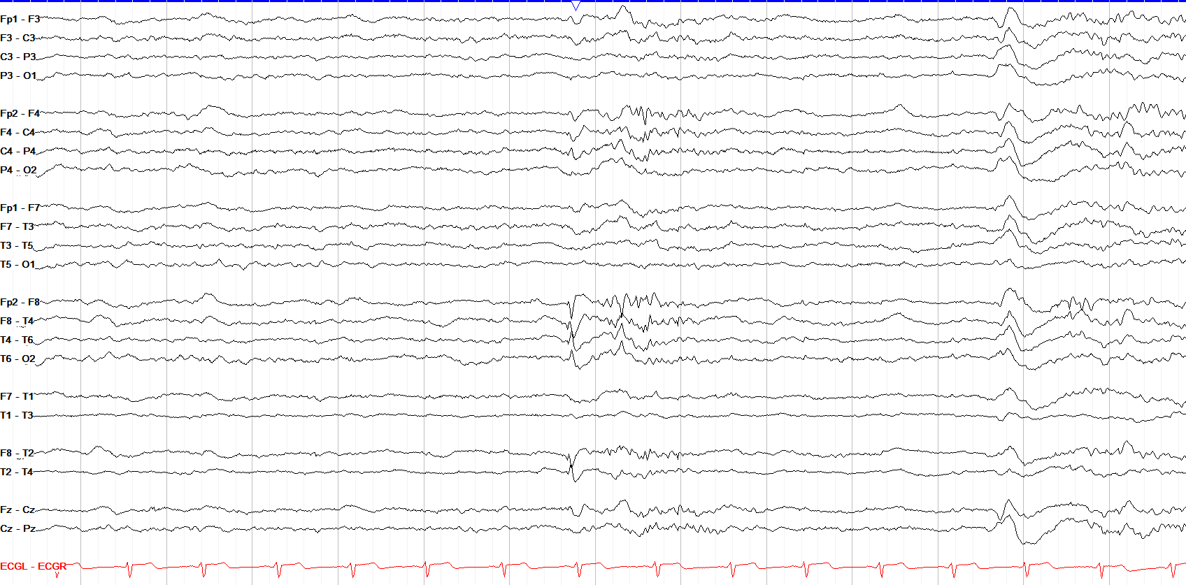 Negative Phase Reversal