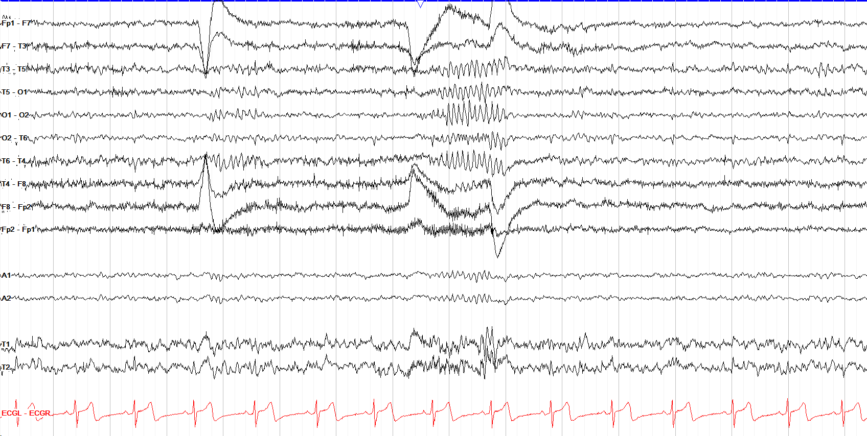 Circumferential Montage
