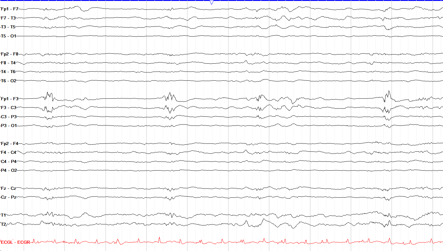 15 μV/mm sensitivity