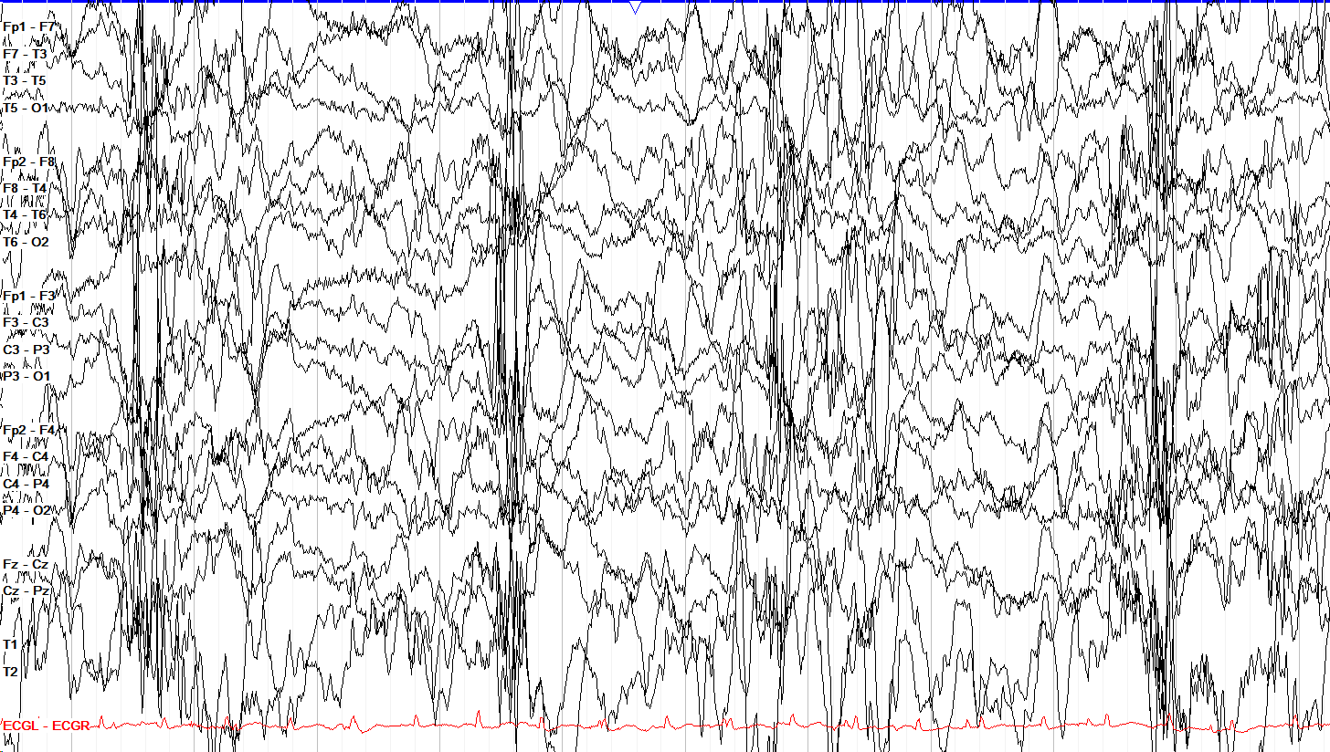 1 μV/mm sensitivity