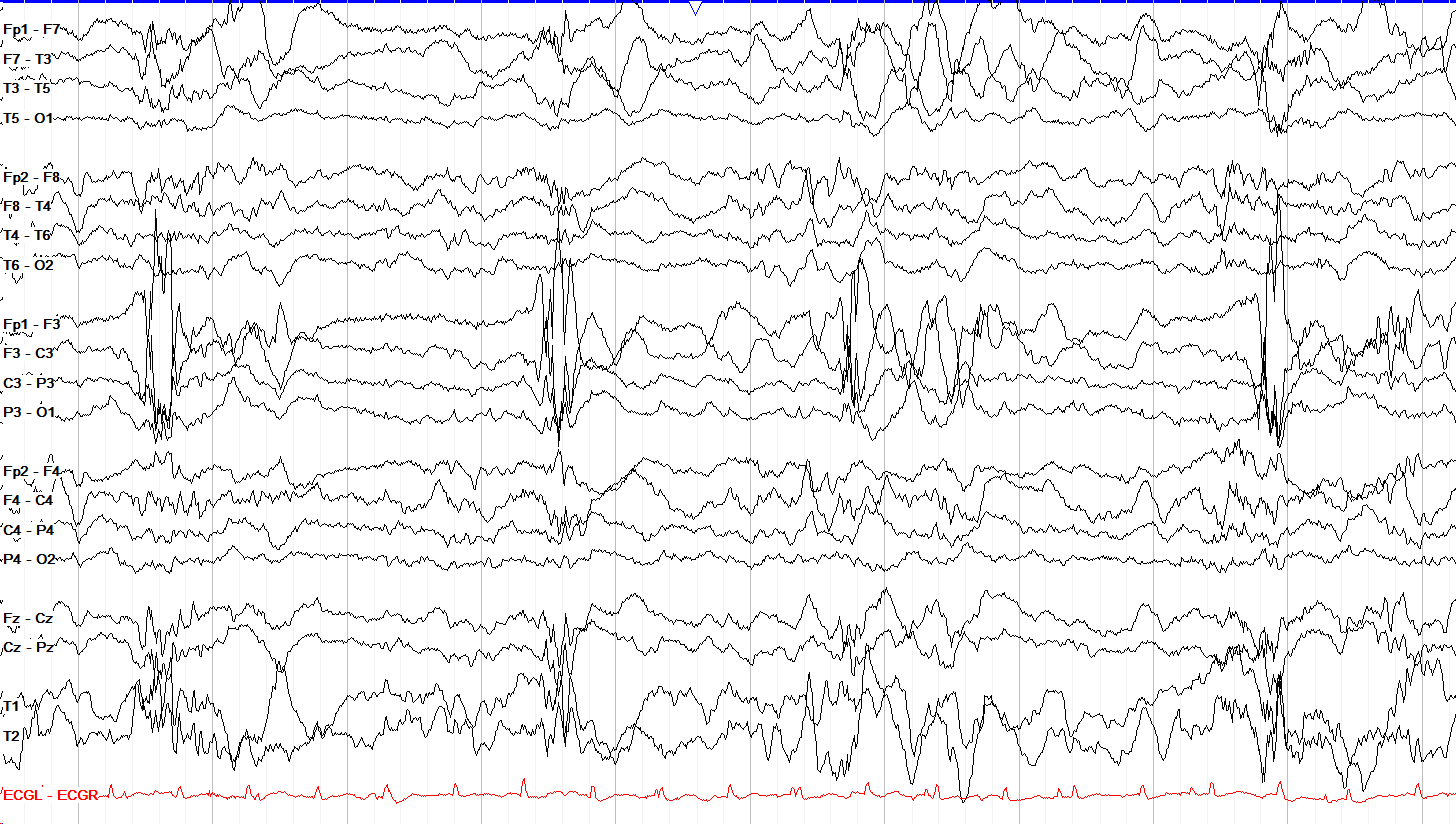 3 μV/mm sensitivity