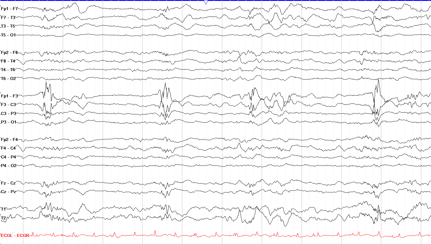 7 μV/mm standard sensitivity