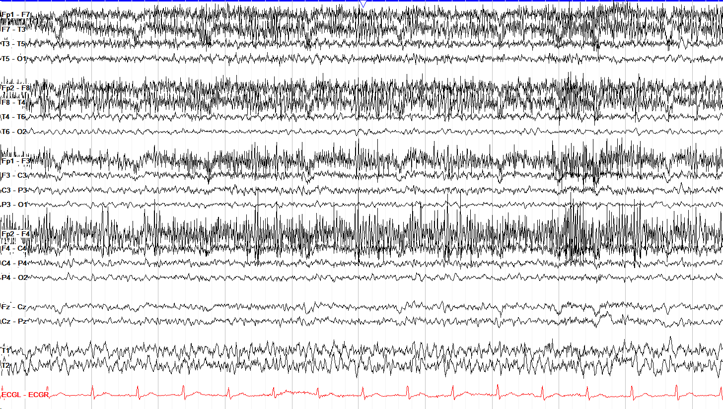 Frontal myogenic artifact with excess beta