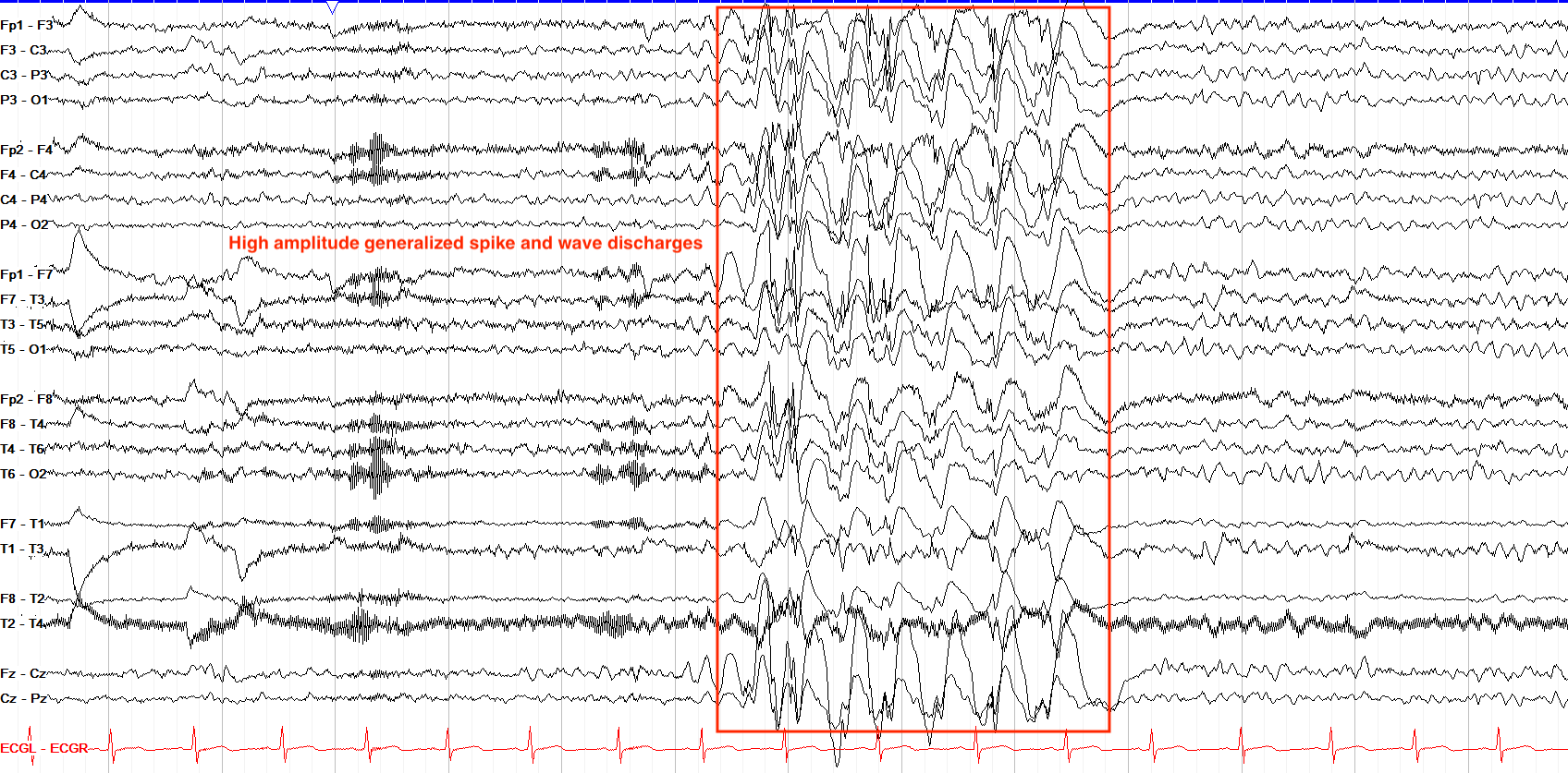 High amplitude generalized spike and waves